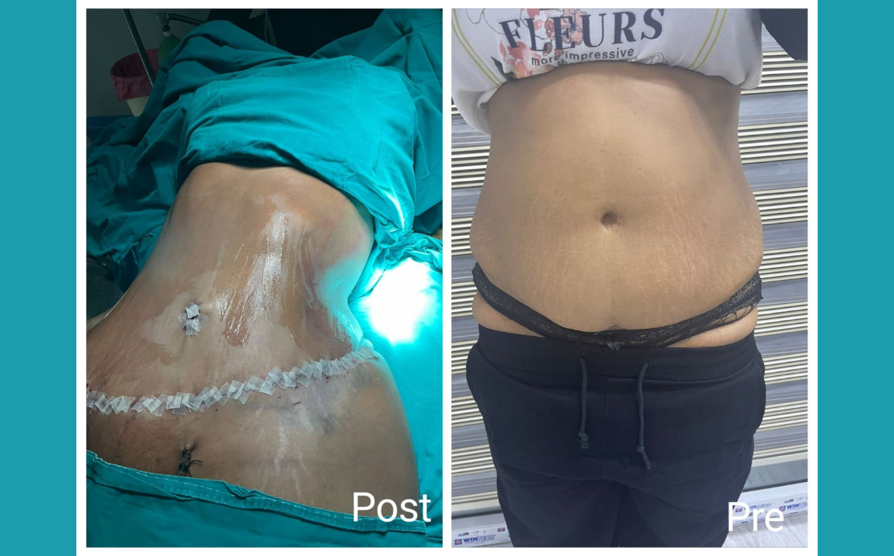 Tummy tuck in Hurghada